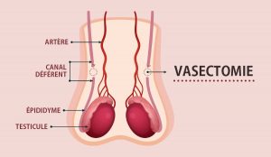 vasectomie